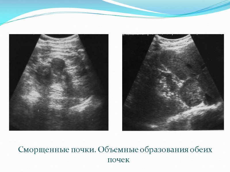 Сморщенные почки. Объемные образования обеих почек